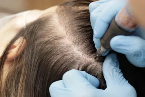 Scalp Micropigmentation Techniques Create the Realistic Hairline Appearances